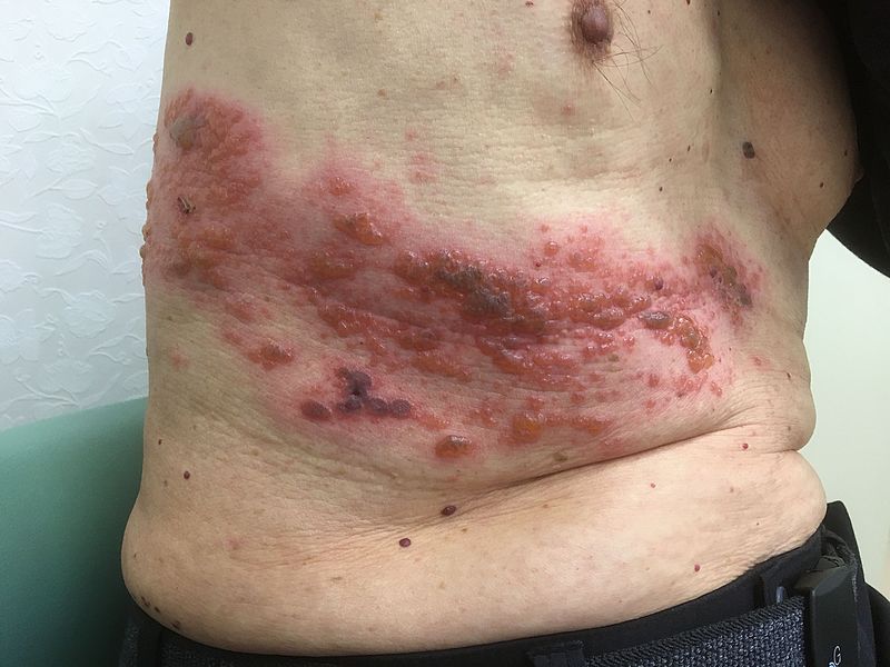 Herpes Zoster Riscos Sintomas E Tratamento Famivita Pt